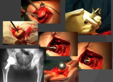Pierwsza na Podkarpaciu implantacja protezy BMHR odbyła się 04.01.2011 roku.
